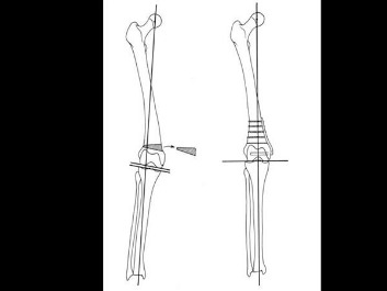 distal femoral osteotomy